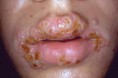 /album/fotogaleria/el-herpes-labial-jpg/